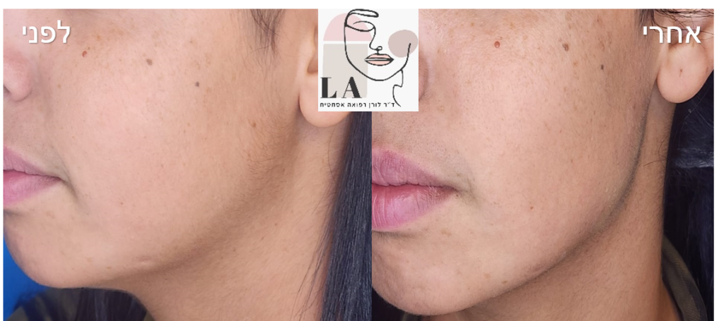 עיצוב קו לסת – lorraine.co.il